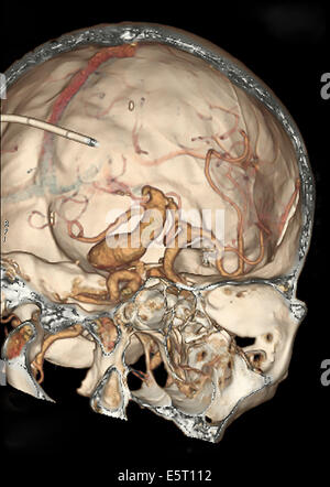 3D Berechnet Computertomographischen CT Scan Rekonstruktion Einer