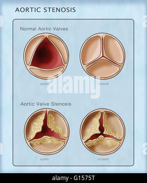 Abbildung Vergleicht Man Einen Normalen Aortenklappe Links Nach