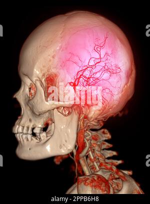 CTA cerebro y arteria carótida o angiografía por TC del cerebro 3D