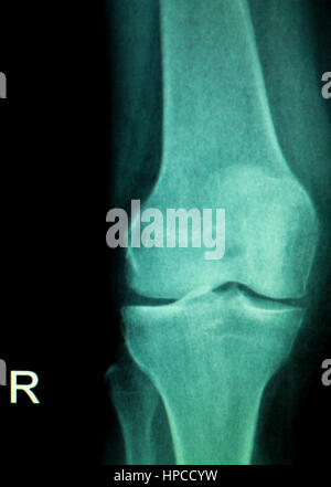 Ortopedia rodilla menisco ligamentos tendones y cartílagos lesión