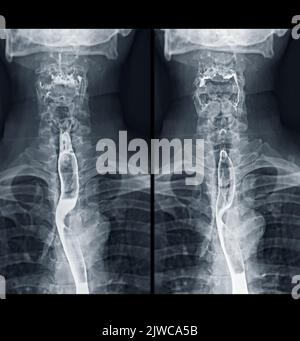 Examen De L Tude De Baryum Swallow Diagnostic De Barrett Examen Du