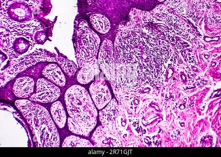 Adénocarcinome intestinal bien différencié micrographe léger photo