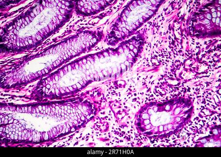 Adénocarcinome intestinal bien différencié micrographe léger photo