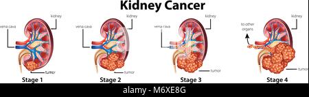 Diagramme Montrant Les Diff Rents Stades Du Cancer Du Rein Image