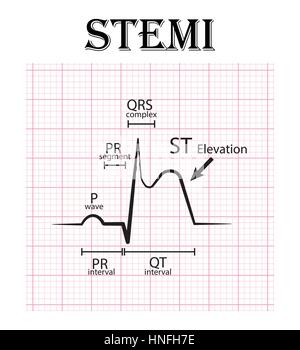 Elettrocardiogramma ECG EKG Di Malattie Ischemiche Del Cuore