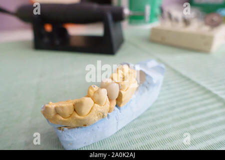 dentist examines artificial dental crowns on a model in his office Stock Photo