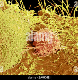 Prostate cancer cells, SEM Stock Photo