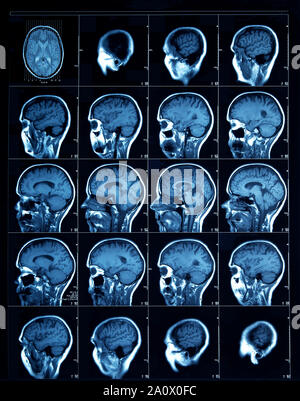 Sliced section CT scan of a human head, showing the cerebral cortex through to the sinus cavities. Stock Photo