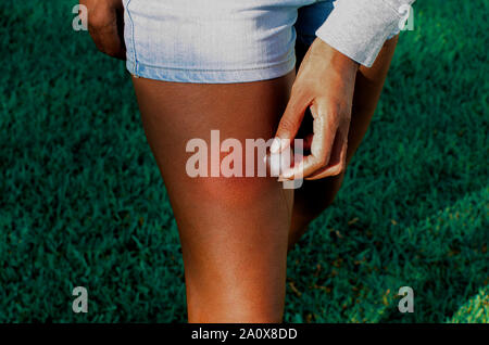 Insect Gadfly Bite On A Black Woman Leg First Day Allergic Reaction insect-gadfly-bite-on-a-black-woman-leg-first-day-allergic-reaction