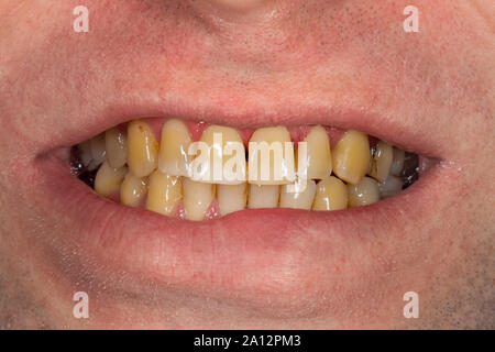 smoking, plaque on teeth    human teeth after smoking. Brown resinous plaque on teeth close-up. Smoking harm concept Stock Photo