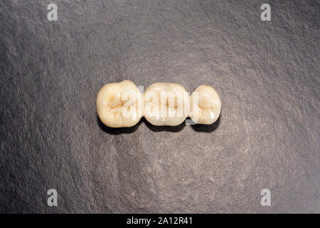 Dental veneers, ceramic and zirconium crowns of teeth close-up macro isolate on black background. Laboratory technical production  prostheses Stock Photo