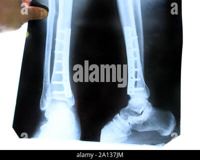 x-ray of the leg. A steel plate holding together the tibia of the leg. Stock Photo