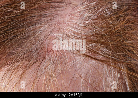 Sore greasy skin and sparse gray hair on the head of a senior  elderly woman. Studio macro shot Stock Photo