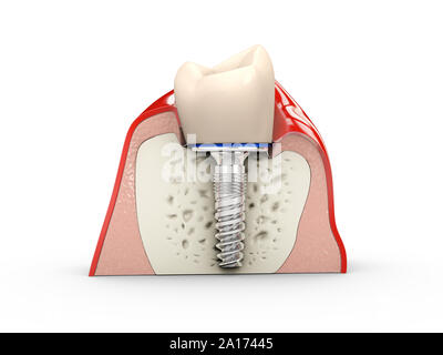 Human teeth and Dental implant 3d Illustration. Stock Photo