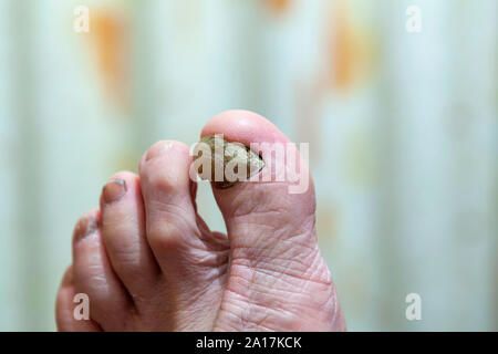 Big toe with fungal nail infection at an advanced stage Stock Photo