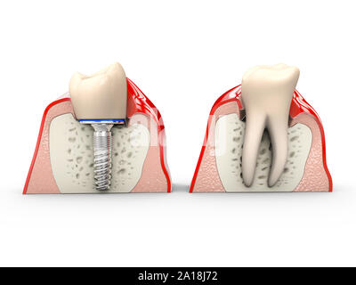 Human teeth and Dental implant 3d Illustration. Stock Photo