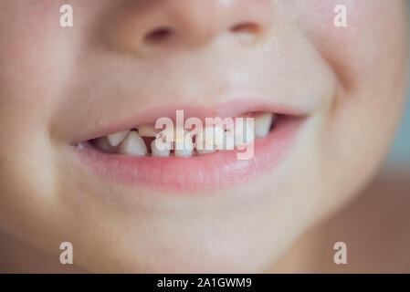 close up shot of baby teeth with caries. Stock Photo