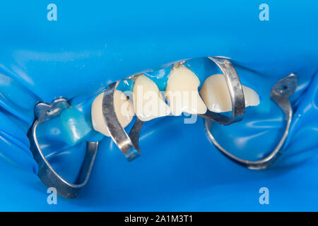 filling of human teeth, close-up. Treatment with polymer fillings at dentist’s appointment Stock Photo