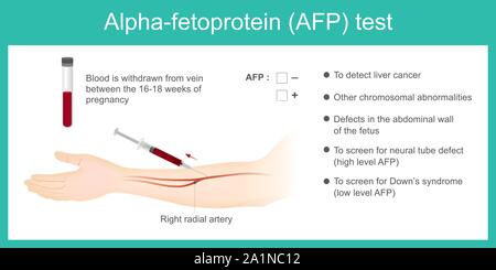 Alpha-fetoprotein (AFP) Test. Use Analysis By AFP Level. To Detect ...