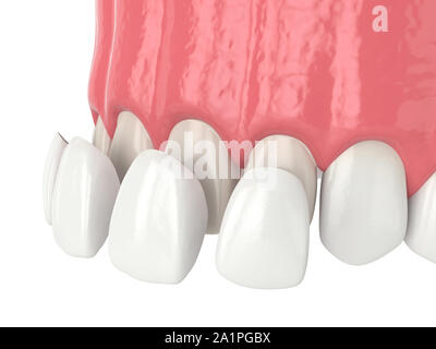 3d render of upper jaw with four veneers over white Stock Photo