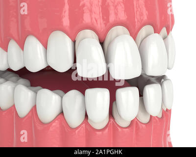 3d render of jaw with upper and lower veneers over white Stock Photo
