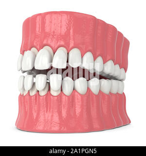 3d render of jaw with upper and lower veneers over white background Stock Photo