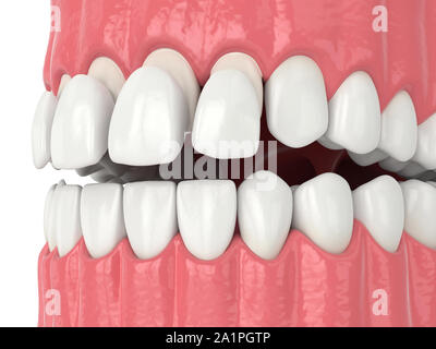 3d render of jaw with teethand upper veneers over white Stock Photo