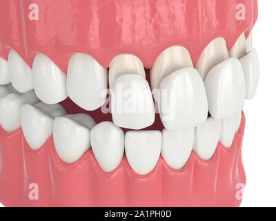 3d render of jaw with upper veneers over white Stock Photo