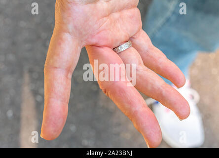 A right hand with a swollen finger after a bee bite Stock Photo