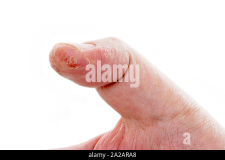 Flaky skin on the finger Stock Photo - Alamy