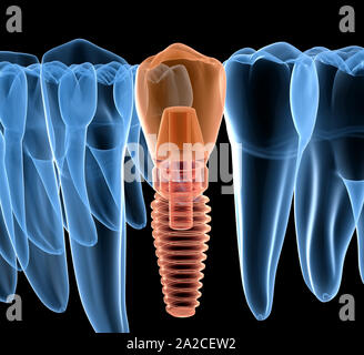 Premolar tooth recovery with implant, x-ray view. Medically accurate 3D illustration of human teeth and dentures concept Stock Photo
