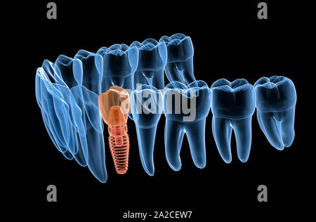 Premolar tooth recovery with implant, x-ray view. Medically accurate 3D illustration of human teeth and dentures concept Stock Photo