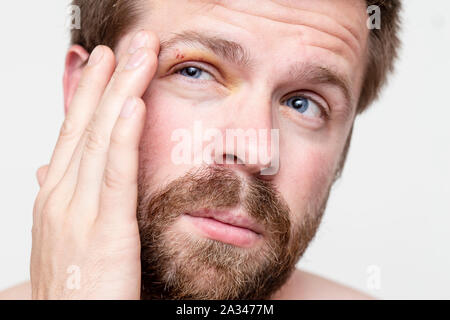 The man got eye injury and is experiencing pain, holding his head by hand. Close-up. Stock Photo