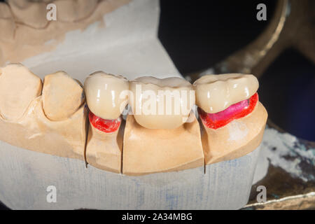 Dental veneers, ceramic and zirconium crowns of teeth close-up macro isolate on black background. Laboratory technical production  prostheses Stock Photo