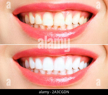 woman teeth before and after whitening. Over white background Stock Photo