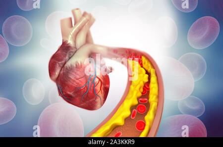 Cholesterol plaque in artery with Human heart anatomy. 3d illustration Stock Photo
