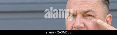 Man pointing to his swollen inflamed left eye showing a bacterial infection or stye of the upper lid and conjunctivitis with purulent discharge in a m Stock Photo