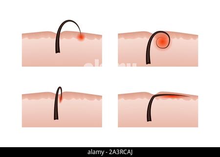 Ingrown hairs after epilation. Vector illustration. Skin structure. Stock Vector