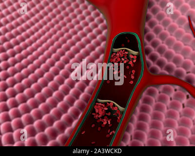 Contraction of blood vessels, a blood clot in the vessels, fat cell in the blood, High quality 3d render of blood cells, cholesterol in a blood Stock Photo