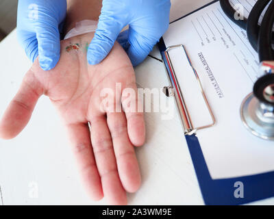 The doctor examines the healing wound of the patient on the hand palm scarring healing Stock Photo