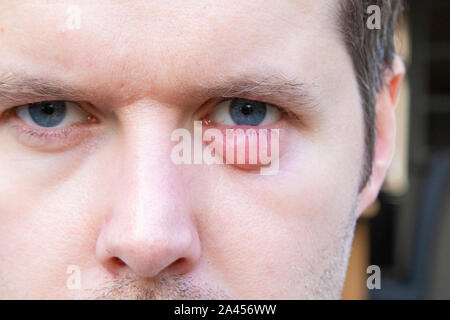 A man with a swollen eyelid due to an infection Stock Photo - Alamy