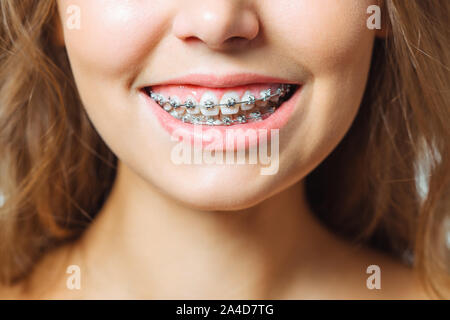 Orthodontic Treatment. Dental Care Concept. Beautiful Woman Healthy Smile close up. Closeup Ceramic and Metal Brackets on Teeth. Beautiful Female Stock Photo