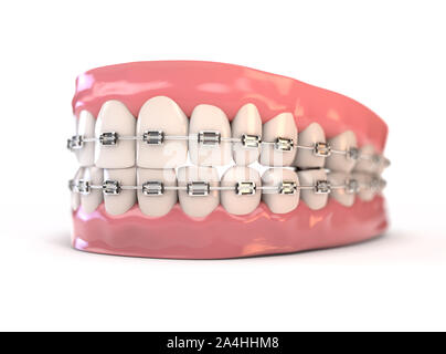 A pair of upper and lower sets of perfect human teeth fitted with steel dental braces on an isolated background - 3D render Stock Photo