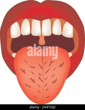 Thrush in the tongue of the child. Candida Stock Photo - Alamy