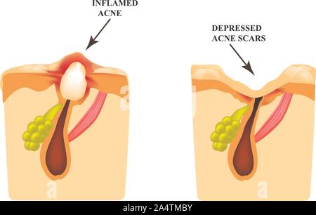 Inflamed acne on the skin. Inflamed pimple. The structure of the skin. Acne scar. Stock Vector