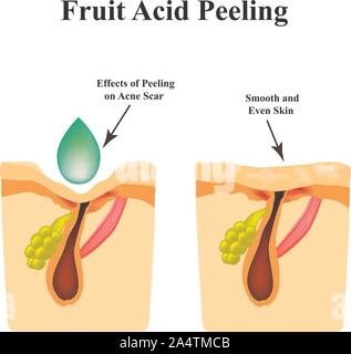 Inflamed acne on the skin. Inflamed pimple. Acne scar. Acid peeling treatment. The structure of the skin. Wrinkles. Infographics. Vector illustration Stock Vector