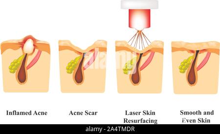 Inflamed acne on the skin. Inflamed pimple. Acne scar. Laser treatment. Laser polishing. The structure of the skin. Wrinkles. Infographics. Vector Stock Vector