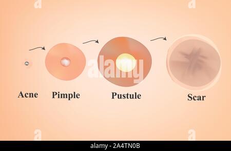 pustule pimple