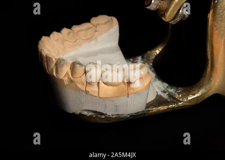 Dental veneers, ceramic and zirconium crowns of teeth close-up macro isolate on black background. Laboratory technical production  prostheses Stock Photo