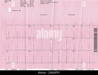 A copy of an ECG (Electrocardiogram) readout from a 60 year-old British male experiencing from Type 2 Hypertension (high blood pressure), on 22nd October 2019, in London, England. Electrocardiography is the process of producing an electrocardiogram (ECG or EKG[a]), a recording – a graph of voltage versus time – of the electrical activity of the heart using electrodes placed on the skin. Stock Photo